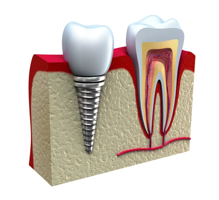 What to Expect During and After Dental Implants Surgery