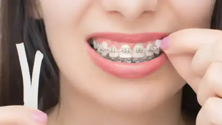 The Clear Choice for Orthodontic Care: Invisalign in Maple Ridge