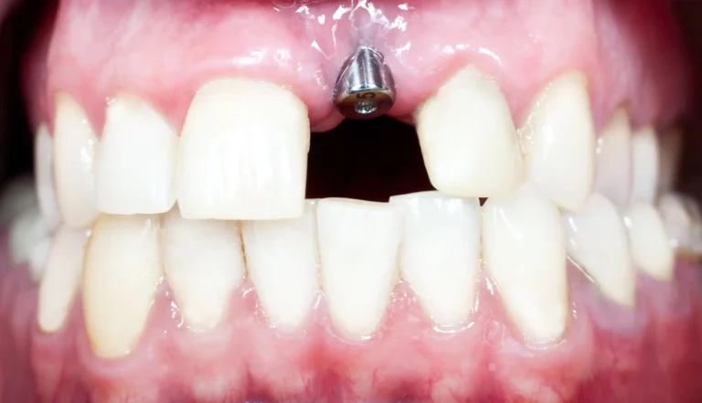 What Are the Options for Replacing Missing Teeth?