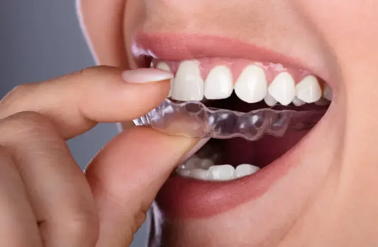 The Evolution of Orthodontics: From Metal Braces to Invisalign Technology