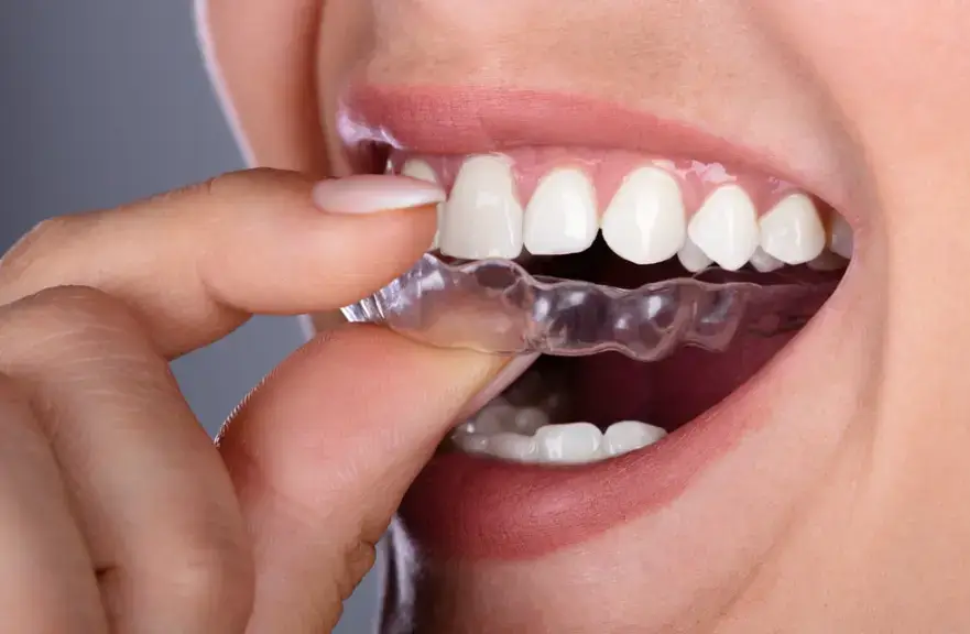 Invisalign